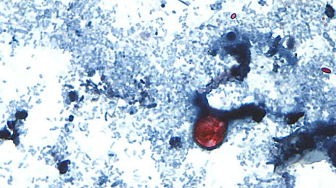 Ohio cyclosporiasis cases caused by cyclospora parasite cross 4,000