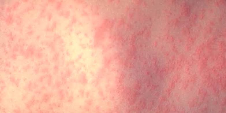 Wayne County Health Department confirms 2 measles cases