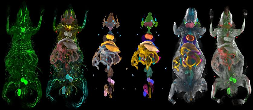 AI atlas reveals hidden whole-body-damage caused by obesity