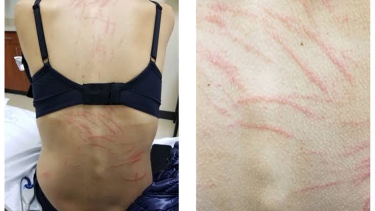Diagnostic dilemma: Whiplike rashes appeared on a woman's back after she ate shiitake mushrooms
