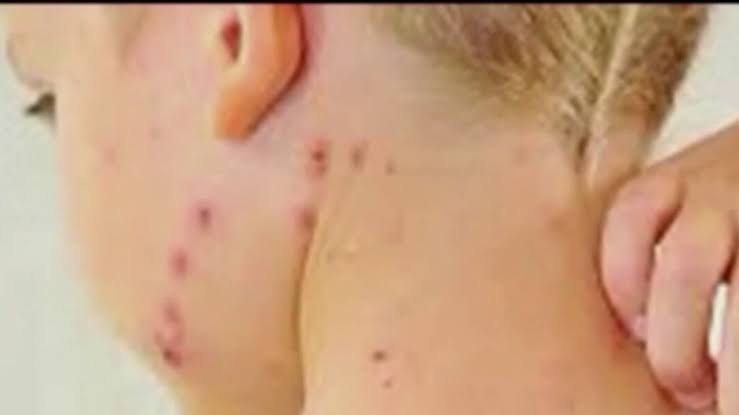 Health officials warn of possible measles exposure at SFO, San Jose locations