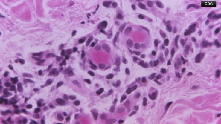 Students warned of possible tuberculosis at metro Atlanta high school