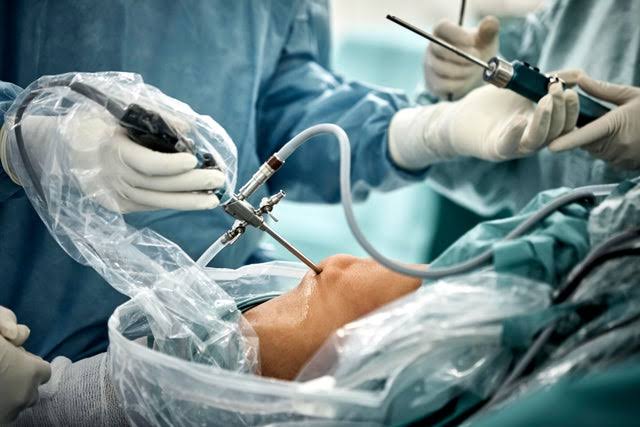 Common knee surgery may do more harm than good: "I don't know how I would defend this procedure"