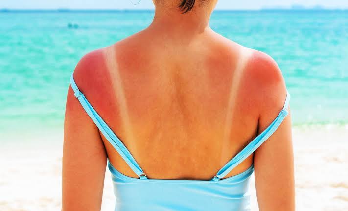 Scientists identify the main cause of sunburns, and now they have to update the textbooks