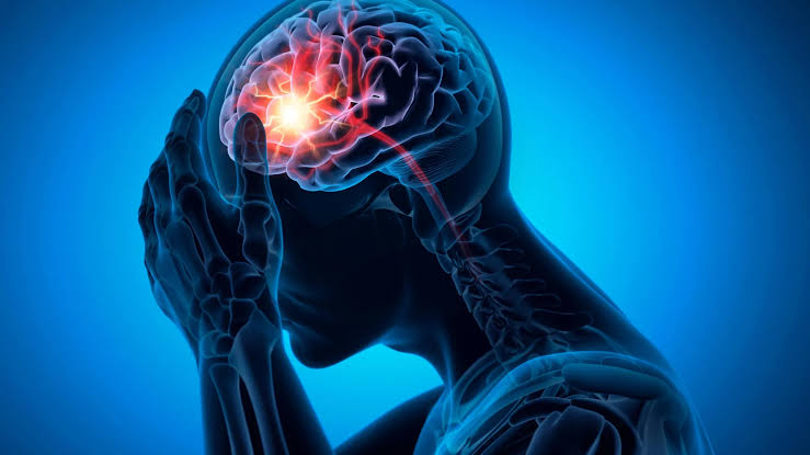 The real cause of a common stroke may have been missed for decades