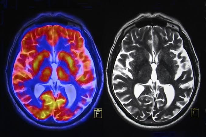 Scientists Link Heavy TV Watching to Brain Changes Decades Later