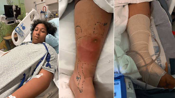 Niceville teen fights for life after Vibrio infection linked to Lions Park waters