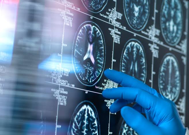 Effect of antiamyloid Alzheimer’s drugs ‘absent or trivial,’ Cochrane review finds