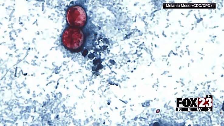 Local doctor shares what people in Green Country should know about cyclosporiasis