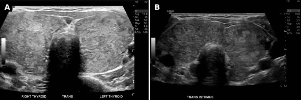 Profound Hypothyroidism as a Reversible Cause of Severe Low-Density Lipoprotein Cholesterol (LDL-C) Elevation: A Case Report