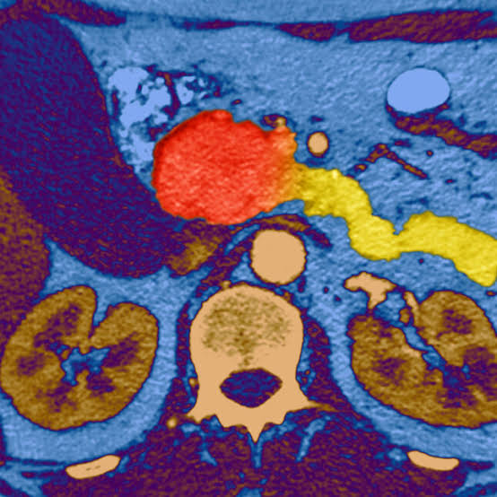 A breakthrough in pancreatic cancer has experts excited — and braced for what’s to come