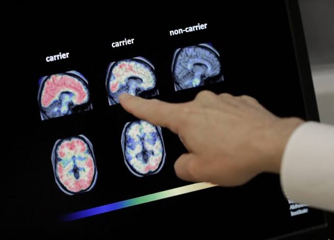 Brain protein Arc may hold key to Alzheimer’s spread, U of U study finds