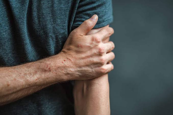 Touch Neurons That Drive Chronic Eczema Itch Revealed