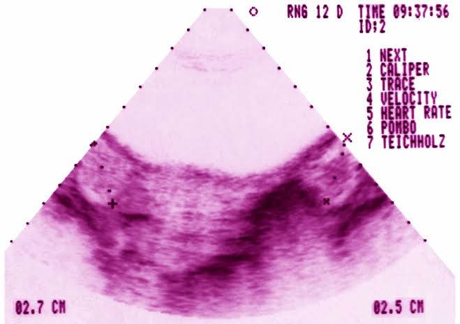 PCOS just got a new name—here’s what to know