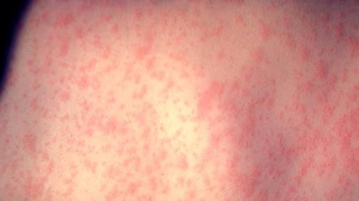 Measles Contracted From Gresham Exposure