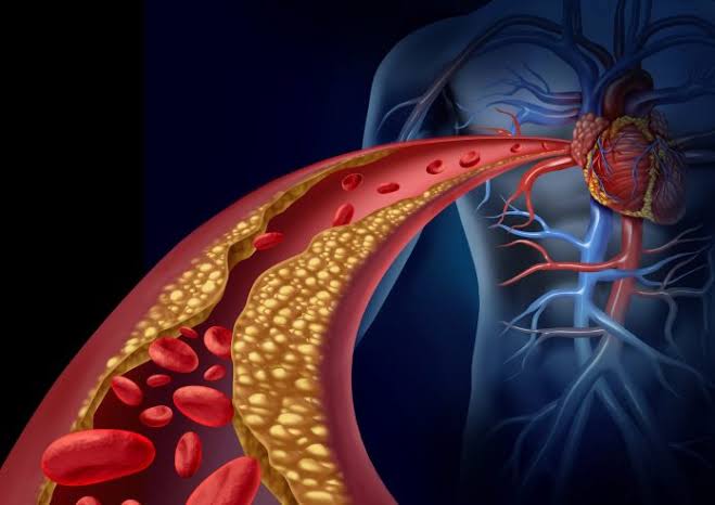 New CVD Risk Tool Boosts Women’s Risk, Lowers Risk for Some Black Adults
