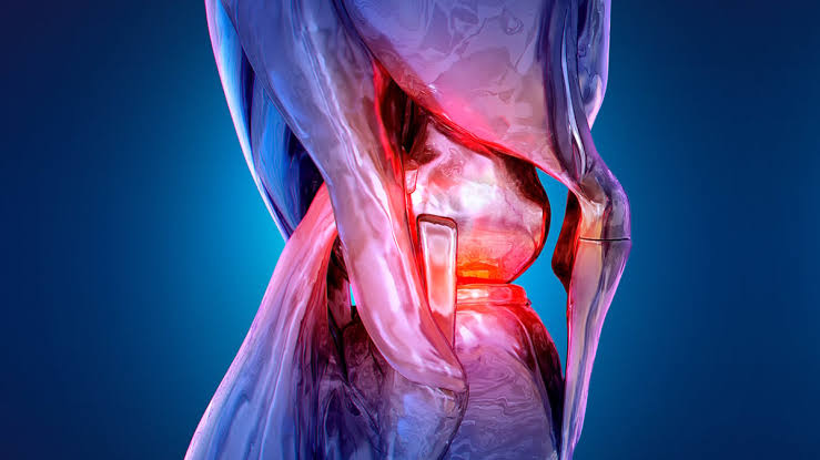 Non-Surgical Procedure Halves Knee Pain Over 12-Month Trial