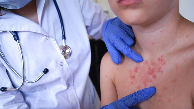 Delaware reports first measles case in more than a decade