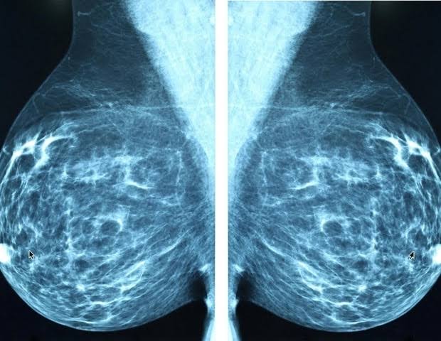 GLP-1 medications linked to lower breast cancer risk in women