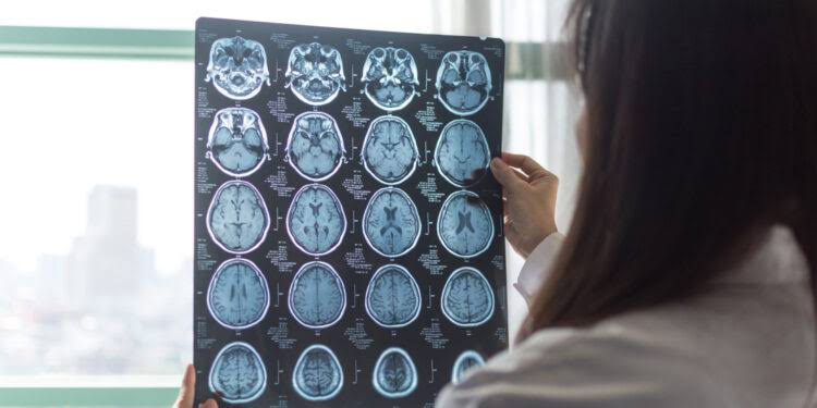 Migraines are linked to accelerated brain aging in regions tied to memory and emotion