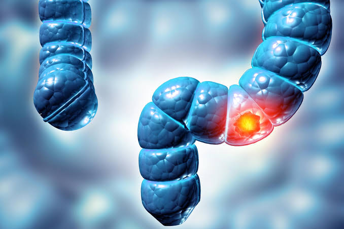 Why More People in Their 30s Are Suddenly Getting Colon Cancer