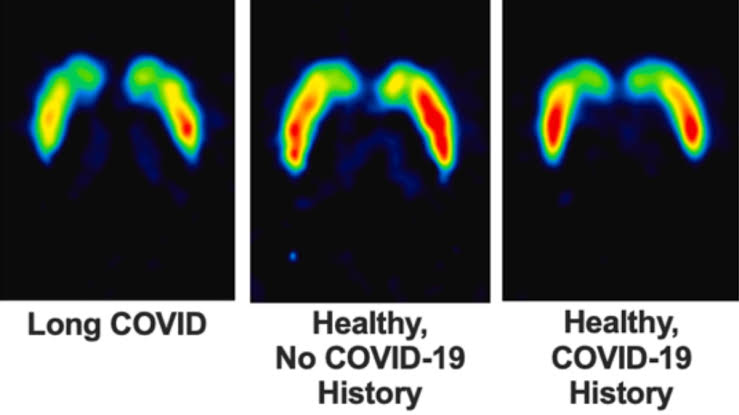 Long COVID Patients Have 18% Fewer Dopamine Nerve Endings, Brain Scans Reveal