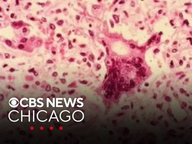 Officials Warn Of Measles Exposure At Terminal 5 At O'Hare International Airport