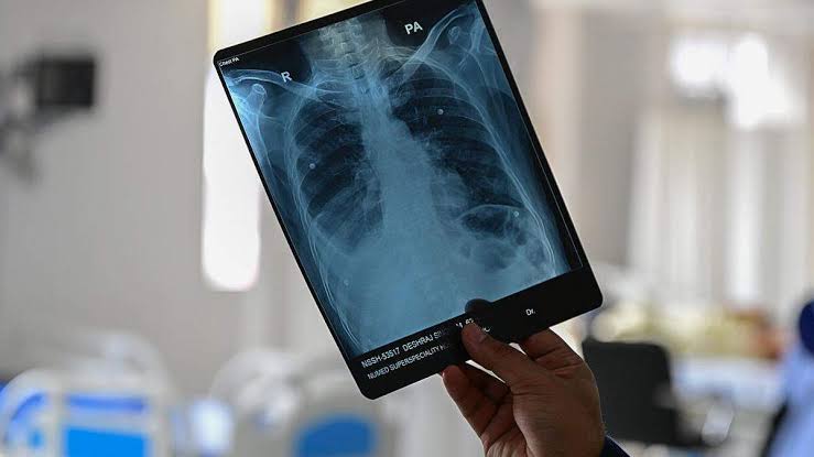 A New Study Found the Hidden Bone Switch That Could Reverse Osteoporosis Before a Fracture Happens