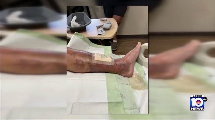 ‘Flesh-eating’ bacteria infections in Florida: 1 dead, 12 confirmed cases, health officials report