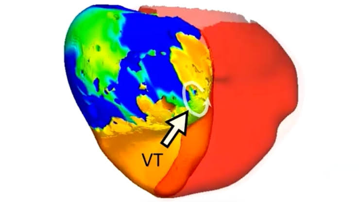 Doctors Treated a Deadly Heart Rhythm With Help From a Digital Twin