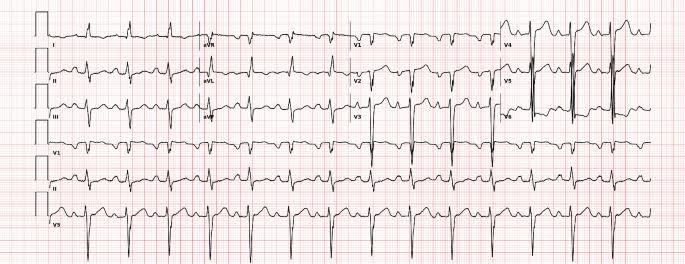 A case of artificial intelligence-enhanced diagnostics leading to heart transplantation