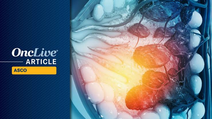 IBCFS With Prosigna-Guided Adjuvant Therapy Is Noninferior to Chemoendocrine Therapy in ER+/HER2– Early Breast Cancer