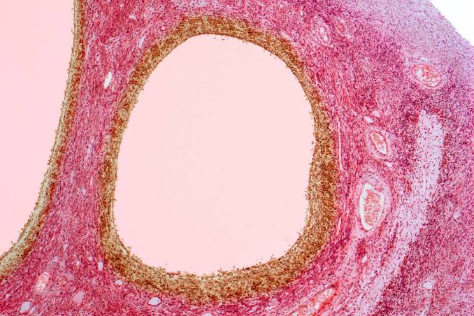 PCOS has been officially renamed PMOS, and it’s a momentous move