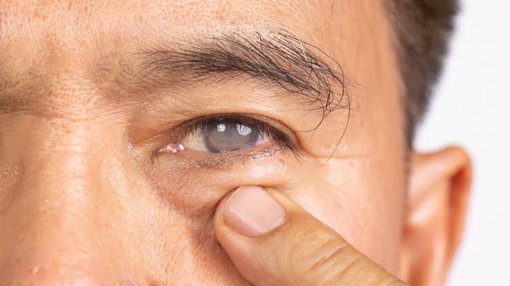 Think cataracts only happen after 60? Doctor warns that diabetes is making this eye condition appear decades earlier
