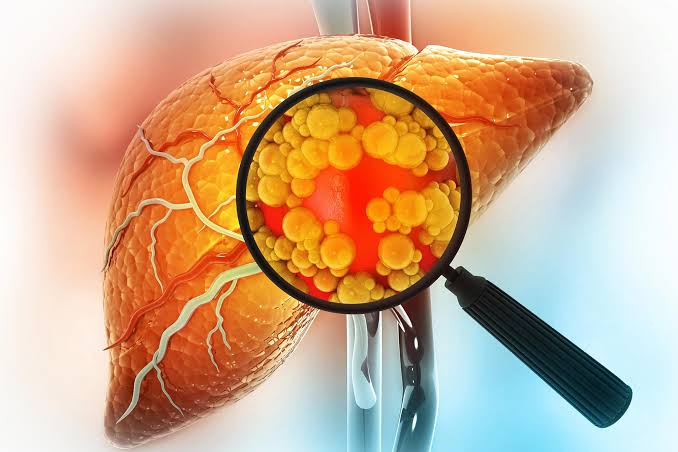 Common Asthma Drug May Reverse Dangerous Fatty Liver Disease