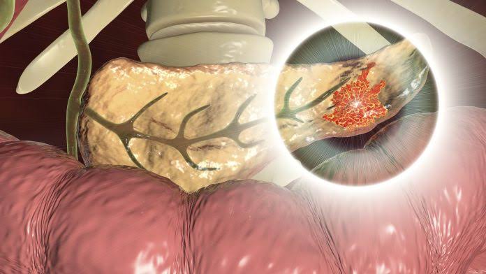 AI Model Can Detect Very Early Pancreatic Cancer from CT Scans