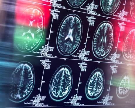 Antidepressants and antipsychotics could serve as alternatives to opioids, study finds