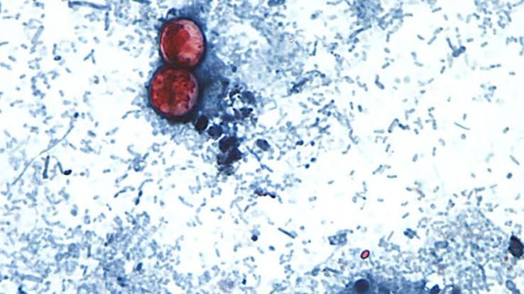 Outbreak of diarrhea from parasite expands to more states as US cases soar beyond last year’s level