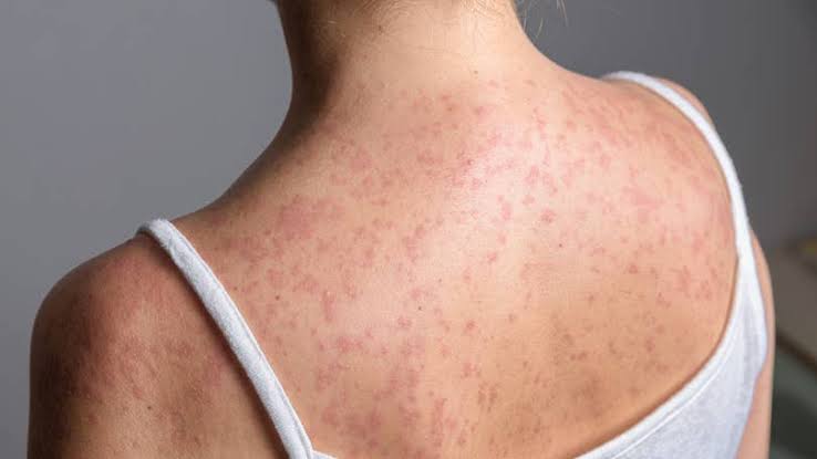 Iowa confirms first measles case of 2026 in Polk County