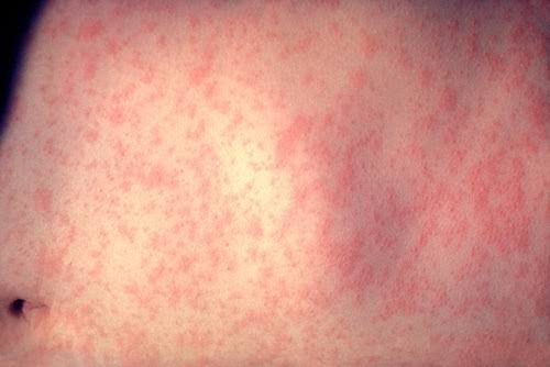 Highly contagious: Viral disease tops 2.3K cases in the US and the numbers are still climbing