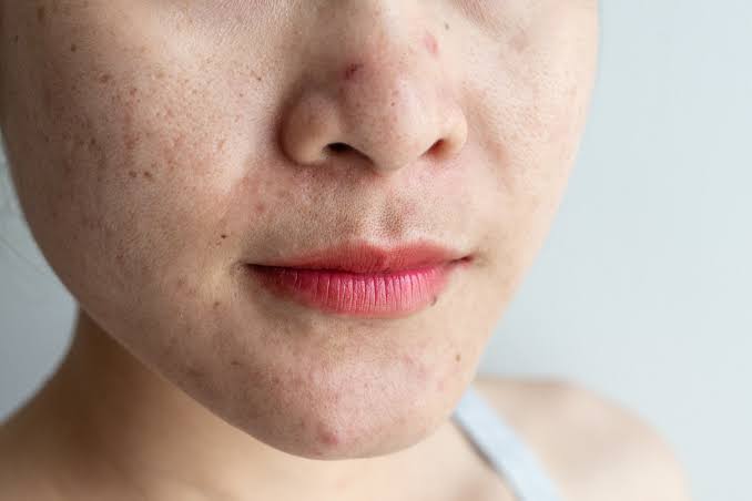Skin Issues Can Signal Heart Problems. Dermatologist Reveals the No. 1 Sign to Look For