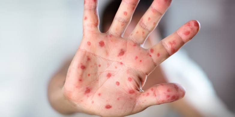Beaverton trampoline park identified as measles exposure site
