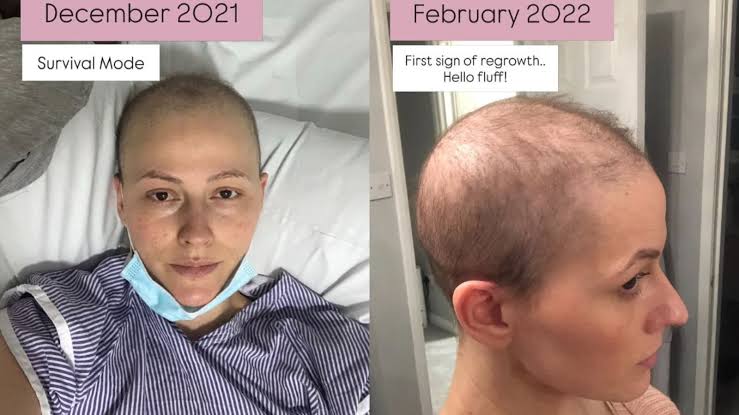 Breast Cancer Survivor Shares What Her Hair Looks Like After Chemotherapy