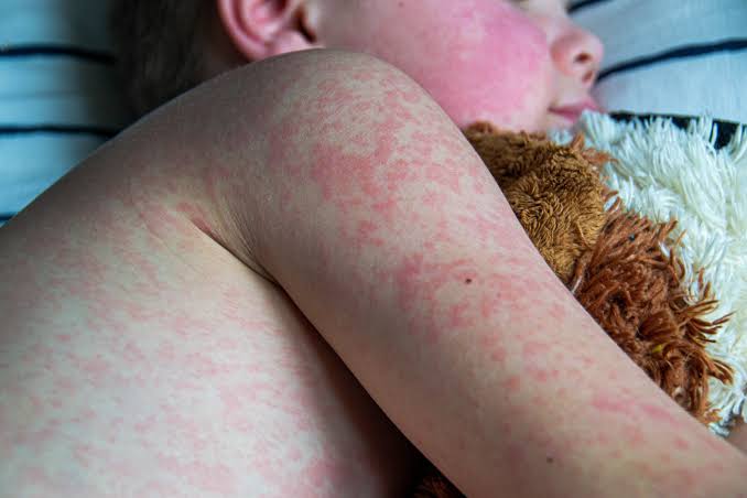 FAQs Amid the Ongoing US Measles Outbreaks