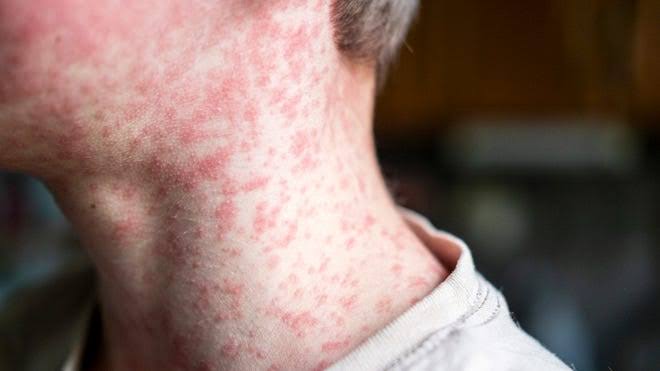 Health officials confirm first two measles cases of 2026 in Tennessee