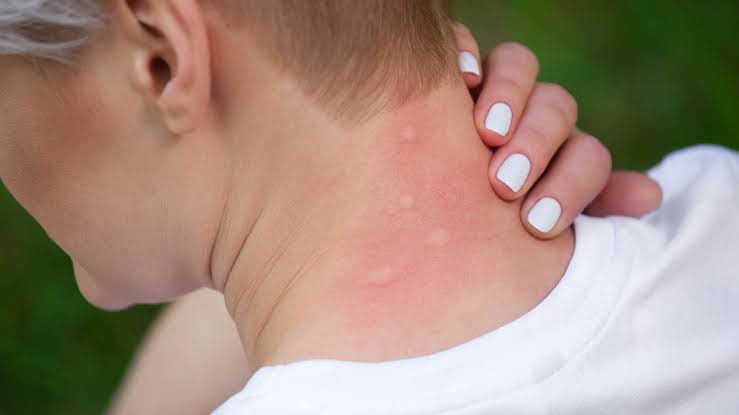 So THAT'S Why Mosquitoes Bite Some People More Than Others