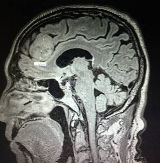 Newton-Wellesley Hospital's brain tumor investigation: New info on the 11 diagnosed nurses