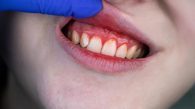 Scientists discover a hidden heart valve risk linked to gum disease