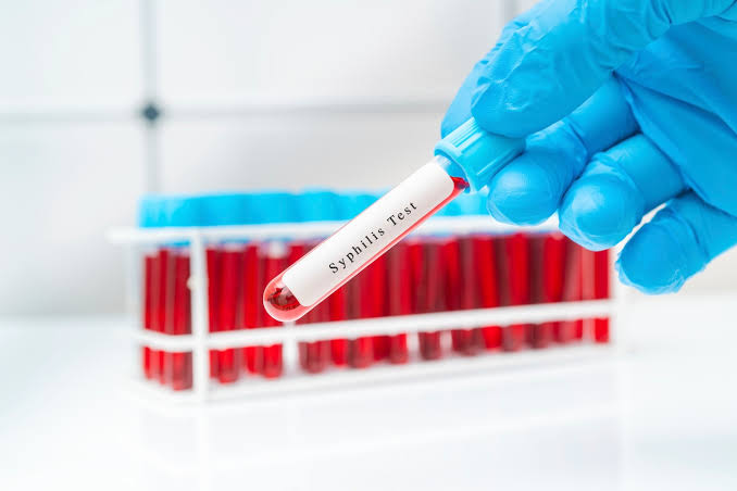 Untreated syphilis on the rise in Alabama with no sign of letting up. Here’s why