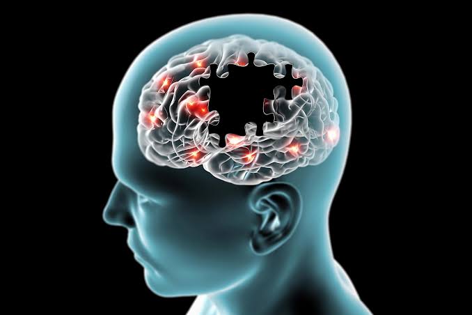 Alzheimer’s May Start With a Surprising Symptom – Not Memory Loss